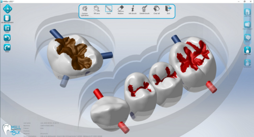 MILLBOX: The Dental CAM software for smart restorations