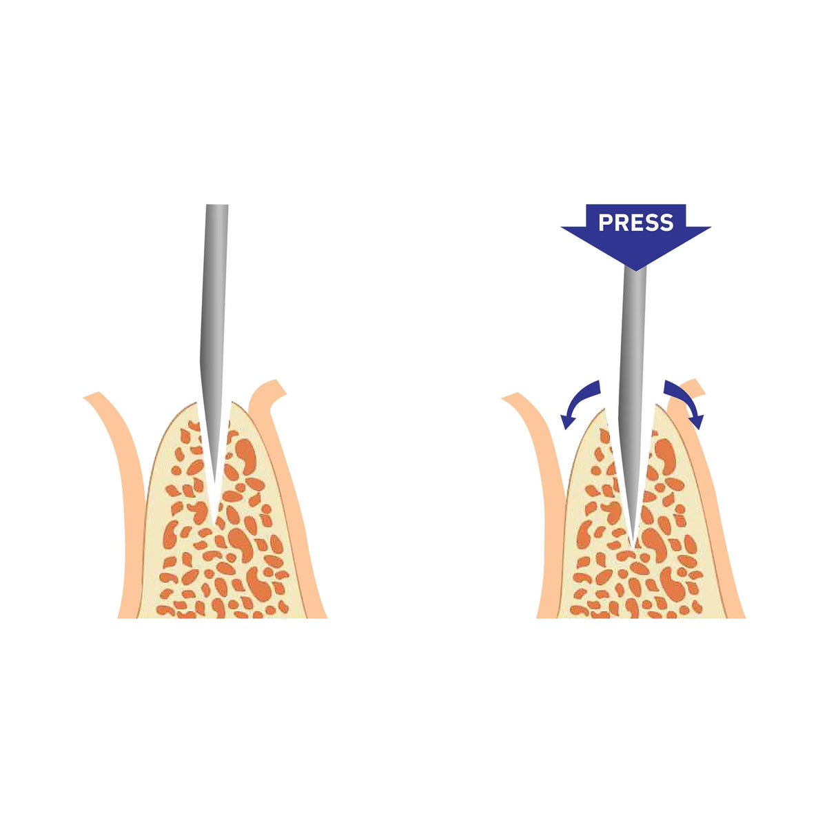 Split Chisel Ridge Split Chisel – Starcona Dental Supply