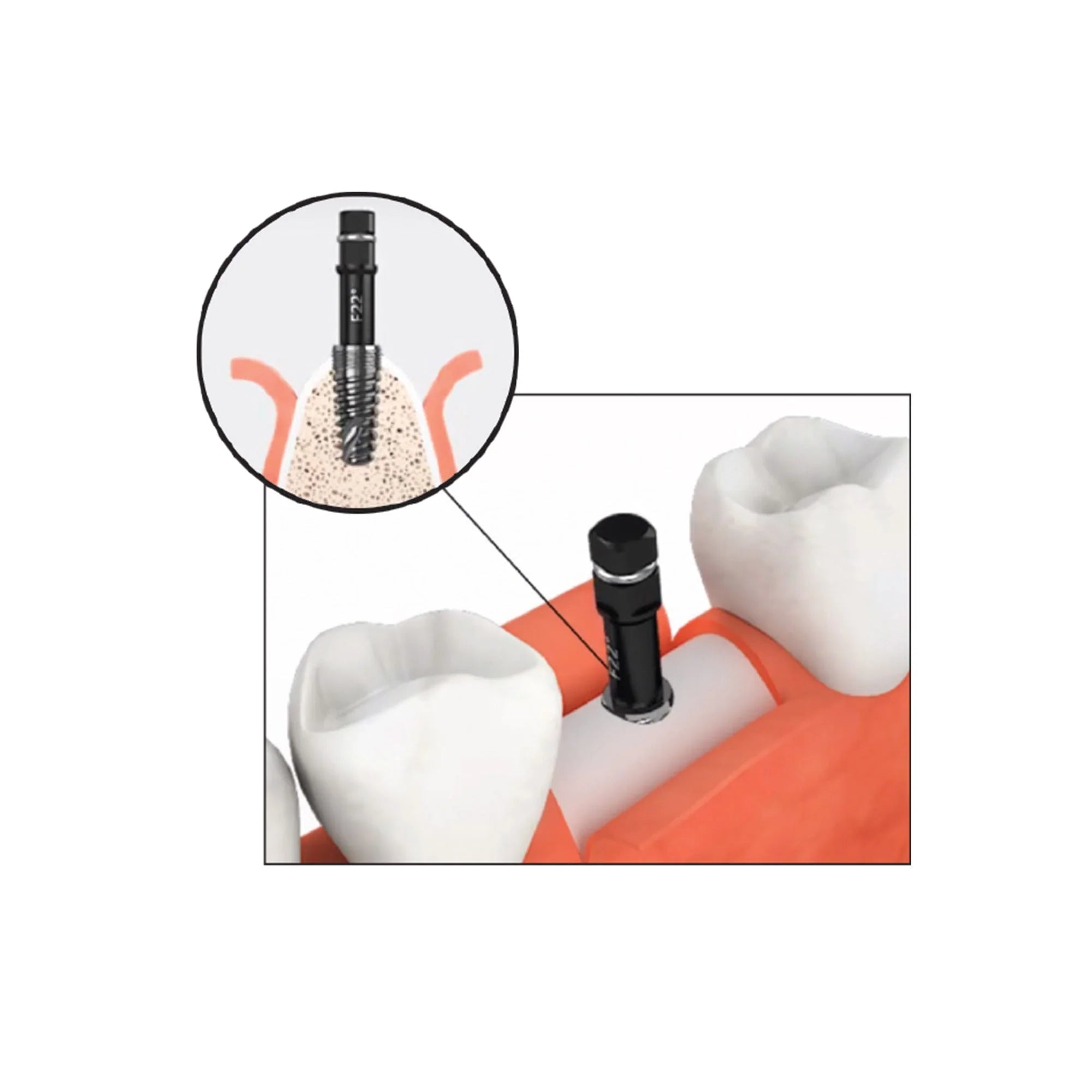 DS-RKS Carbide Fixture Removal (refill)