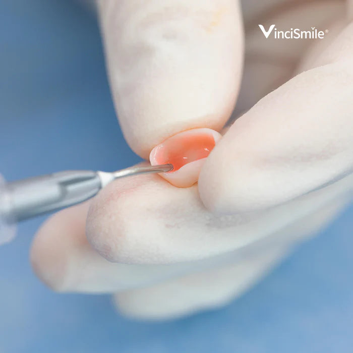 HUGE DENTAL USA HF-Etchant Hydrofluoric Acid Etching Gel