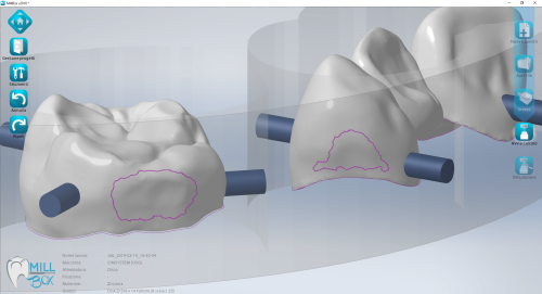 MILLBOX: The Dental CAM software for smart restorations