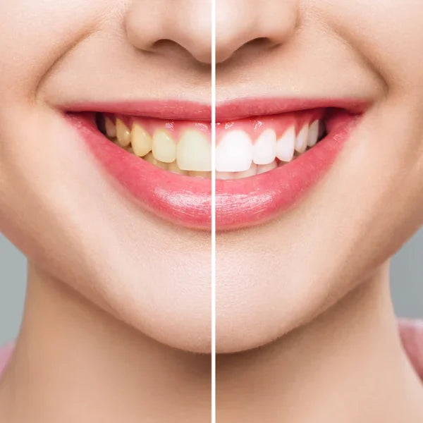 DSI WhitePro Whitening Strips