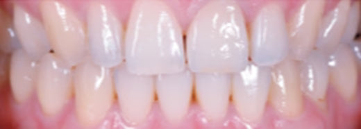 VATECH Perfit FS Zirconia Block – Pre-shaded, Fully Sintered, Crack Resistant