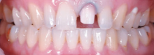 VATECH Perfit FS Zirconia Block – Multilayer, Fully Sintered, Crack Resistant