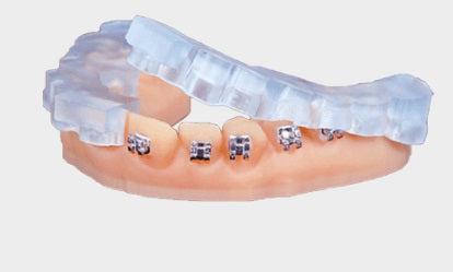KeyPrint KeyOrtho IBT - Starcona Dental Supply