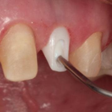 Liquid Magic Resin Barrier Kit