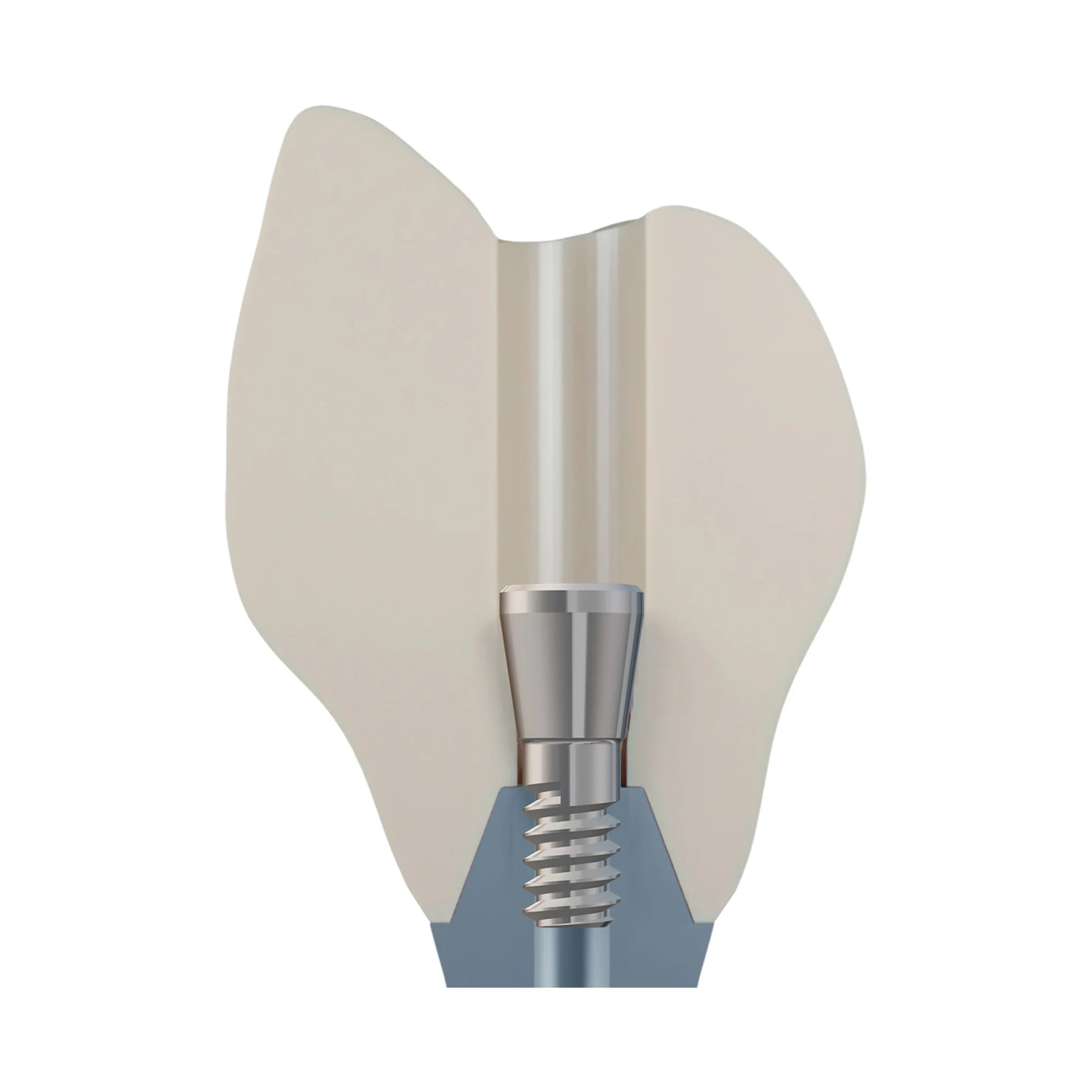 DSI EvoConnect M1.4 - Direct Сonnection Screws for Multi-Unit Abutments